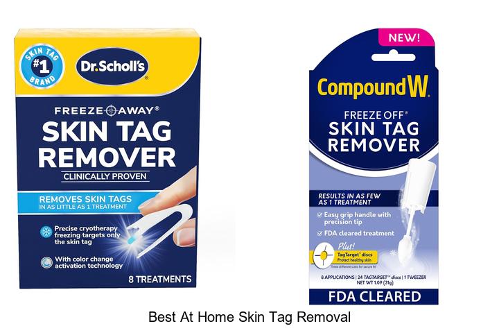 best at home skin tag removal